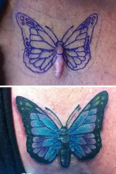 narben-tattoo (1)