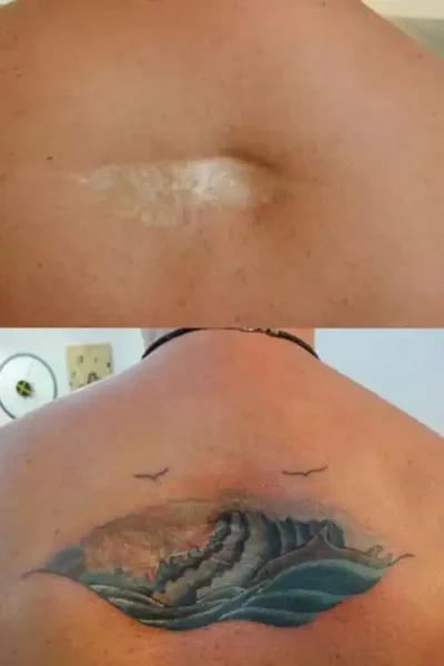 narben-tattoo (2)